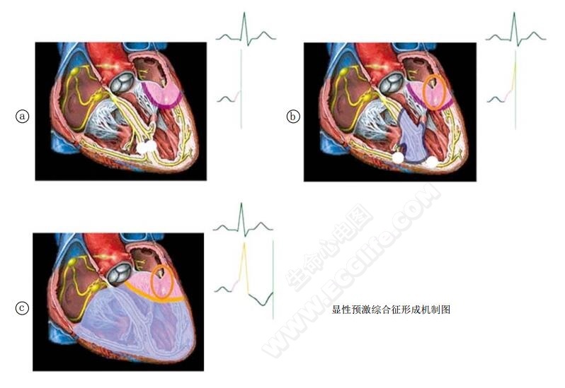 显性预激综合征形成机制图