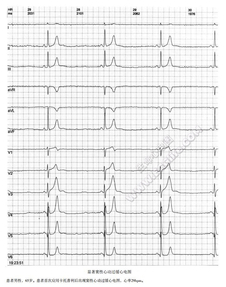 显著窦性心动过缓心电图