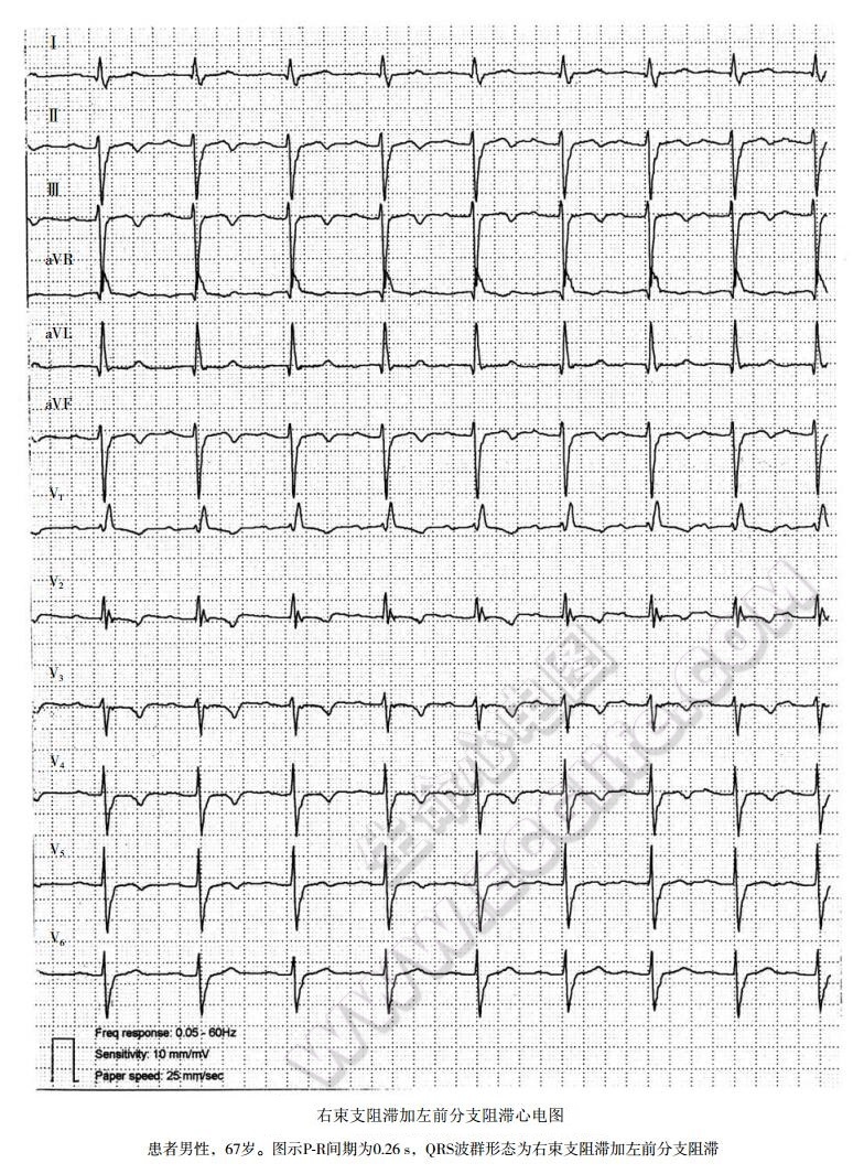 右束支阻滞加左前分支阻滞心电图