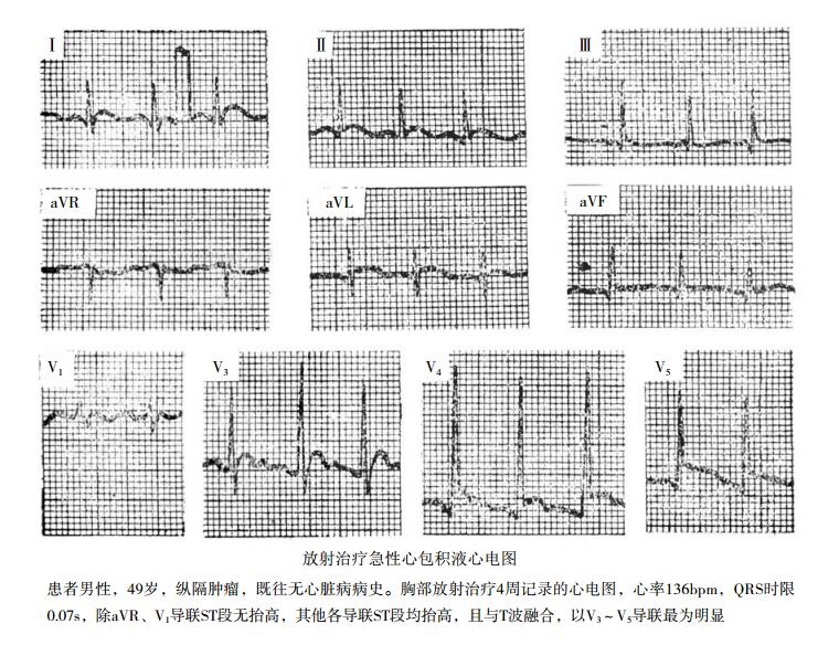 放射治疗急性心包积液心电图
