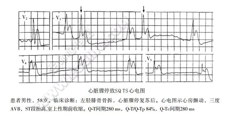 心脏骤停致SOTS心电图