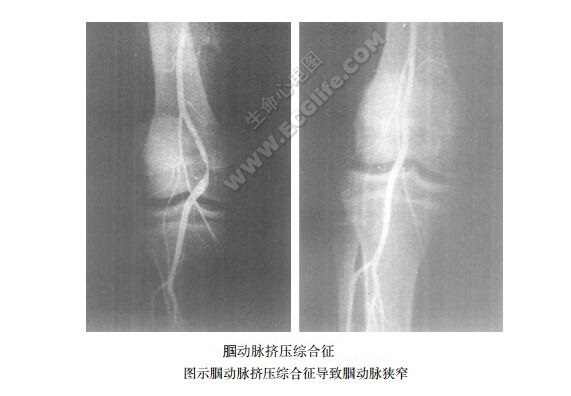 腘动脉挤压综合征导致腘动脉狭窄示意图