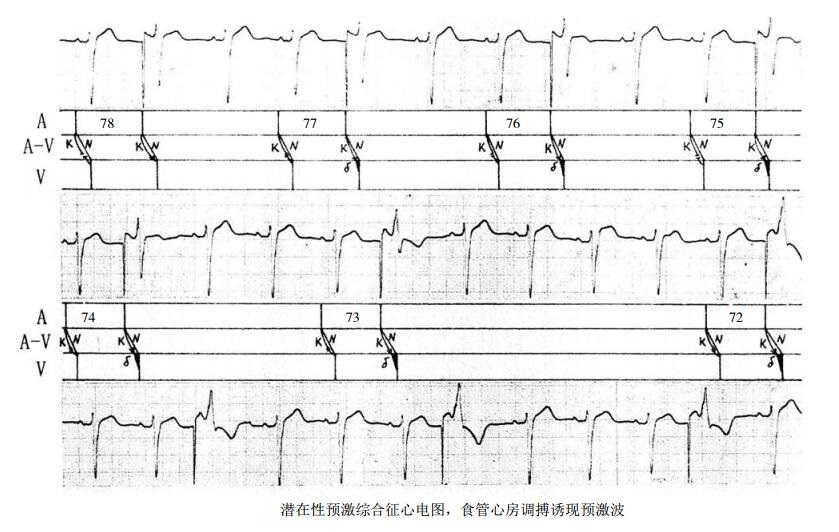 潜在性预激综合征心电图，食管心房调搏诱现预激波