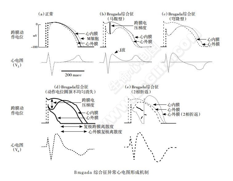 Brugada综合征异常心电图形成机制