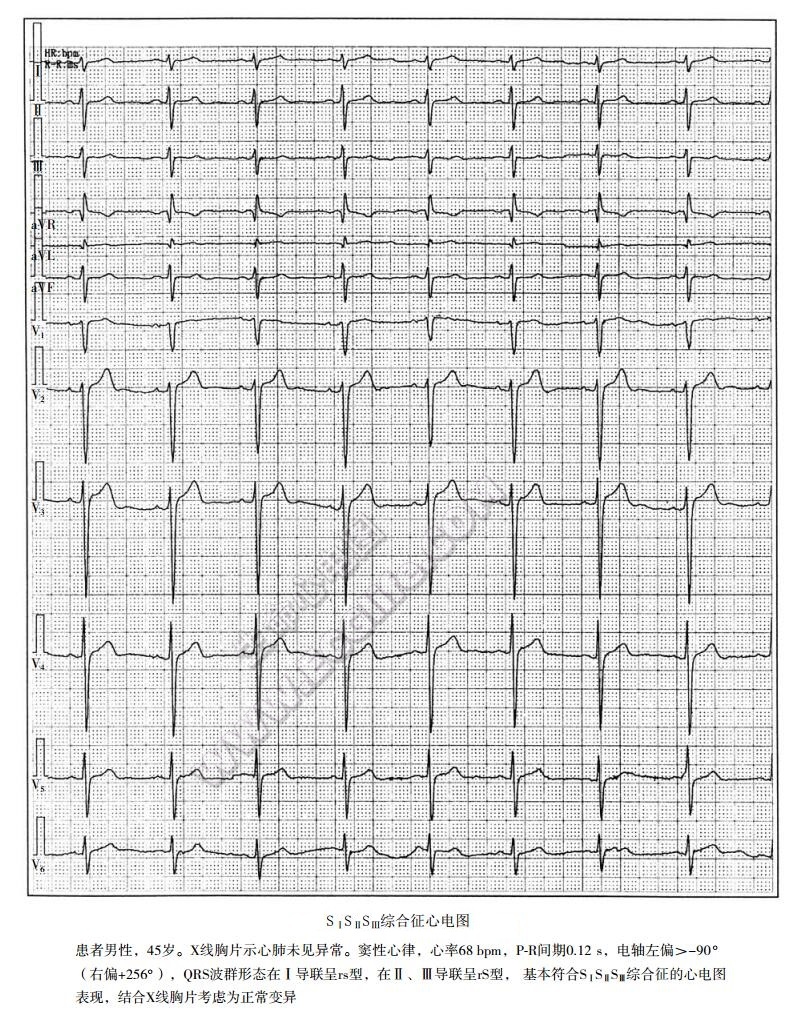3S综合征心电图表现