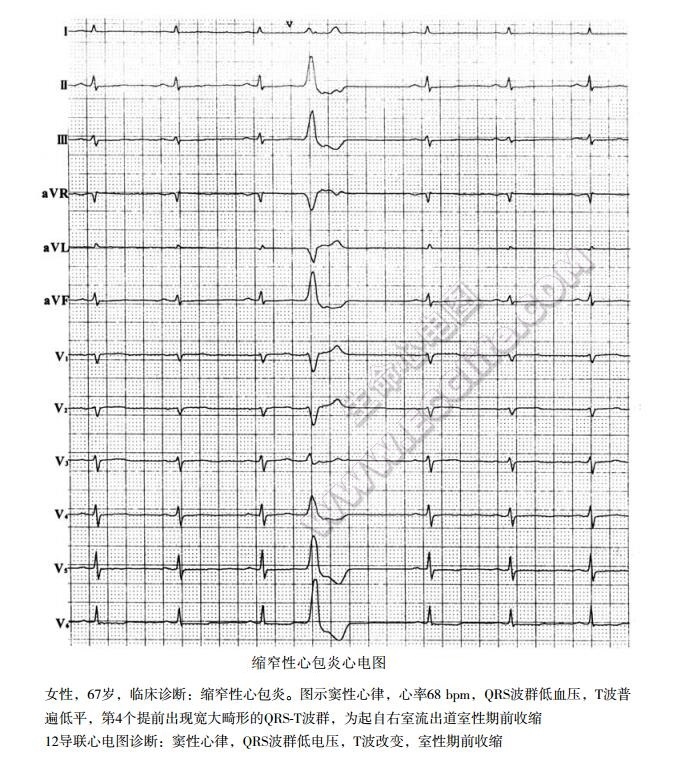 编窄件心包炎心电图