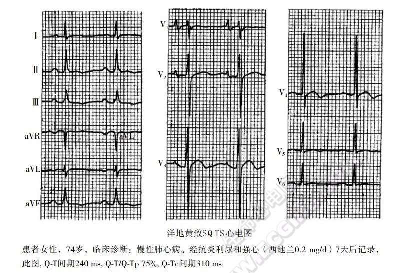 洋地黄中毒致SQTS心电图