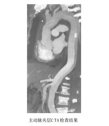 主动脉夹层CTA检查结果