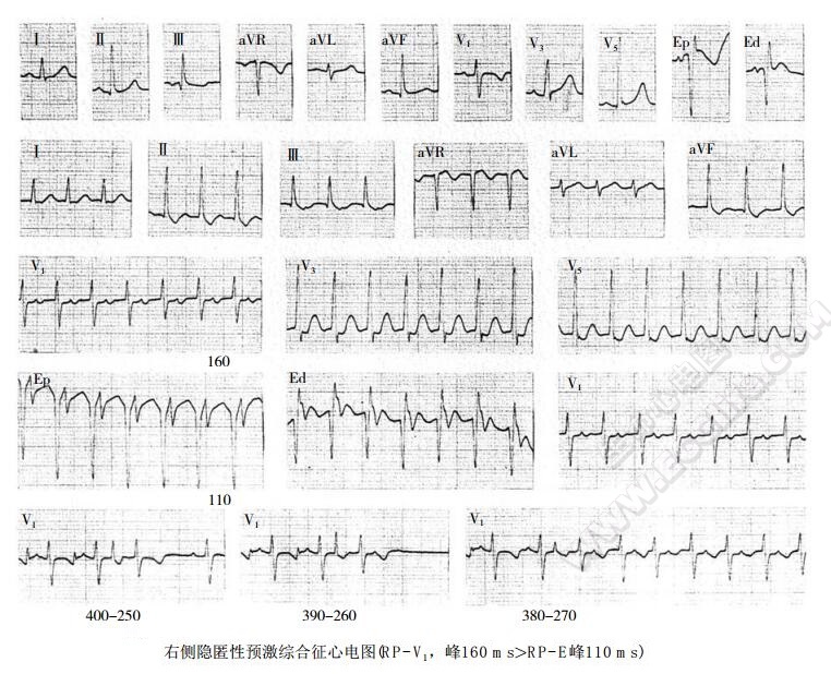 右侧隐匿性预激综合征心电图