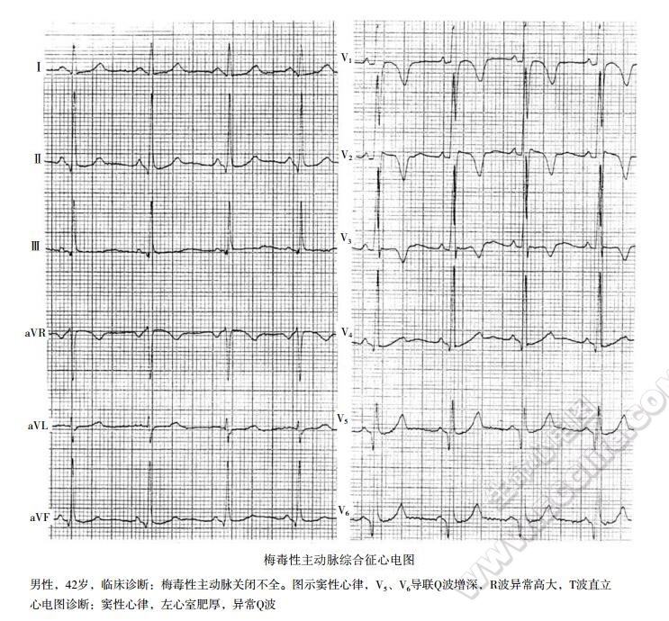 梅毒性主动脉综合征（梅毒性心血管病）