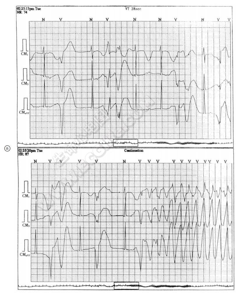 尖端扭转型室速实时动态心电图1