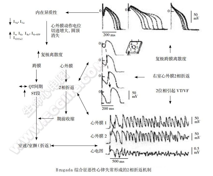 Brugada综合征恶性心律失常形成的2相折返机制