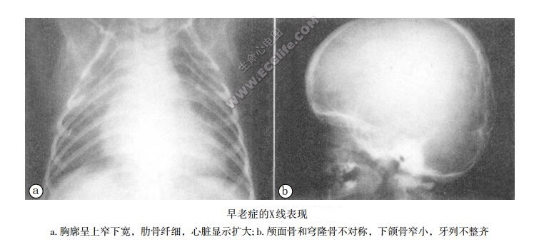 Hutchinson-Gilford综合征（小儿早老症）