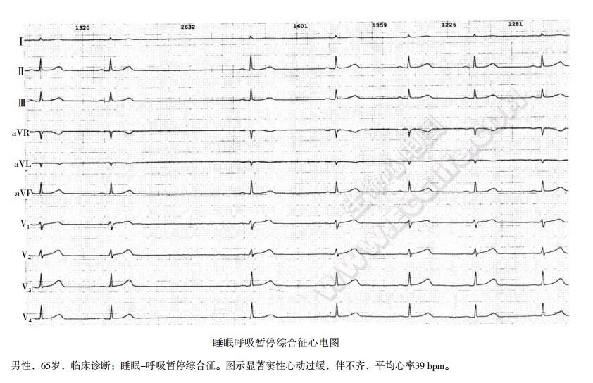 睡眠呼吸暂停综合征心电图表现