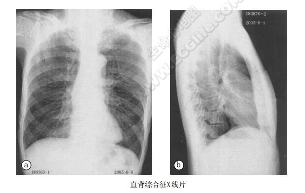 直背综合征胸部X线片图