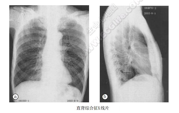 直背综合征（假性心脏病、扁平胸综合征）