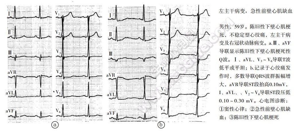 心肌缺血综合征：左主干病变，急性前壁心肌出血心电图表现