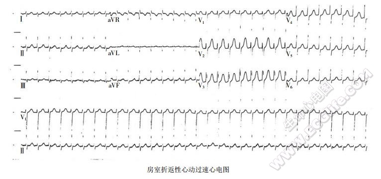 房室折返性心动过速心电图表现