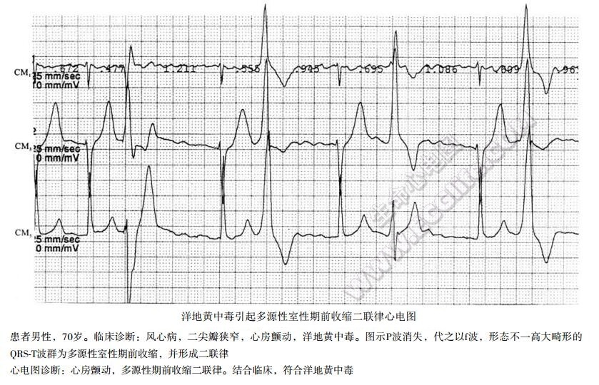 洋地黄中毒引起多源性室性期前收缩二联律心电图