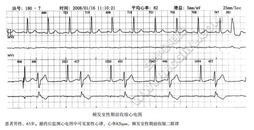 频发室性期前收缩心电图