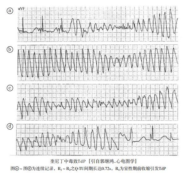 奎尼丁中毒致TdP