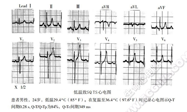 低温致SQTS心电图