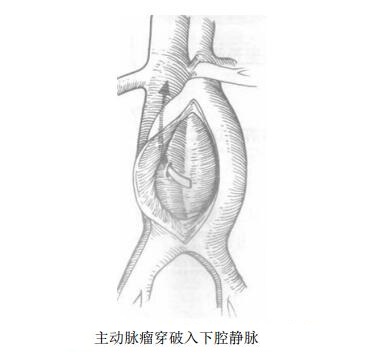 主动脉瘤-下腔静脉瘘综合征