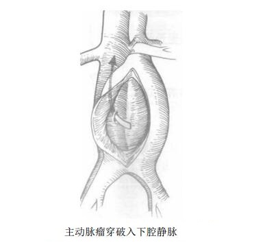 主动脉瘤穿破入下腔静脉