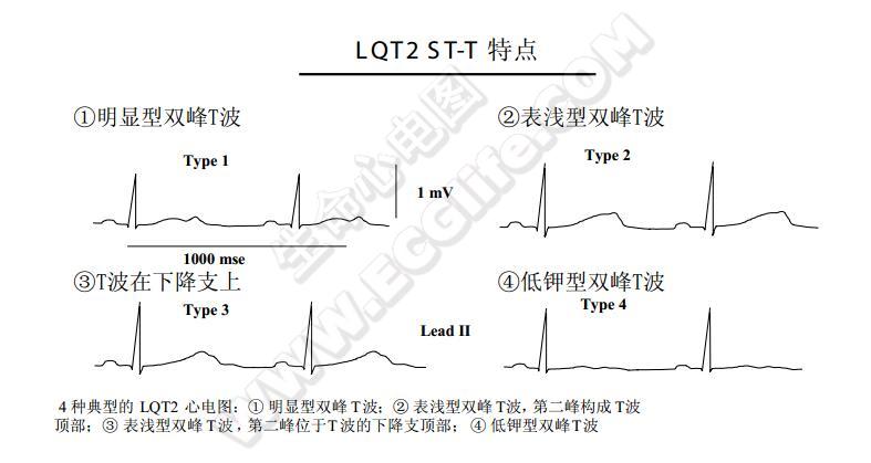 典型的LQT2心电图图形