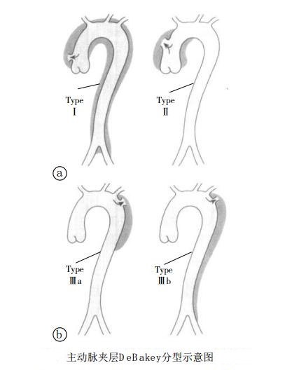 主动脉夹层DeBakey分型示意图