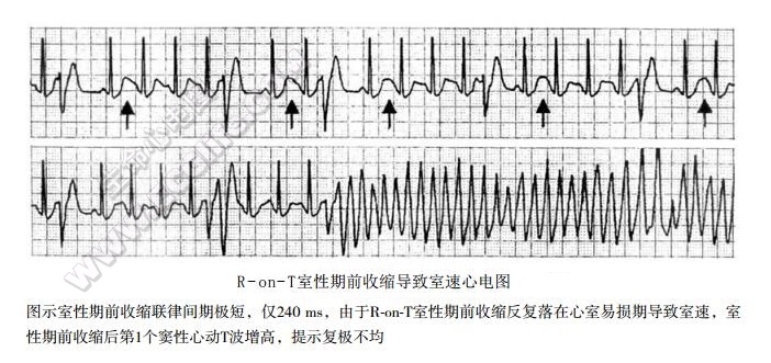 典型ront心电图图片图片