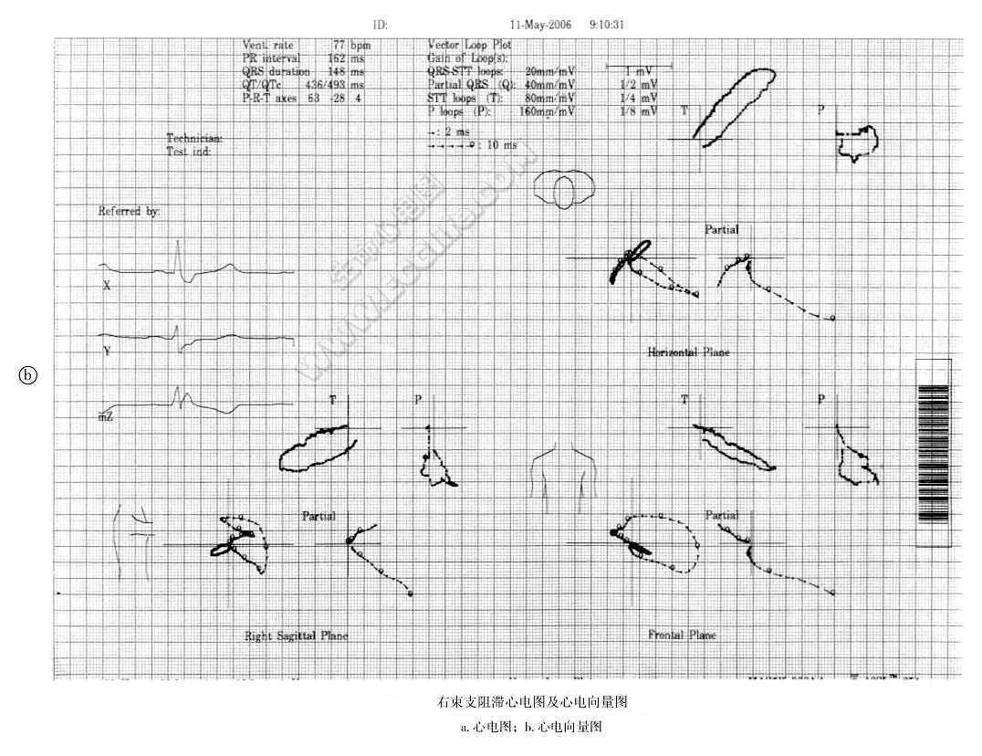 右束支阻滞诊断心电向量图