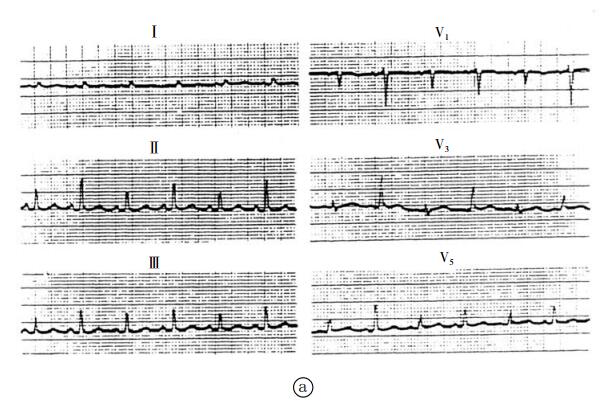 心包积液心电图特征图片