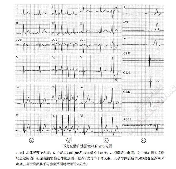 不完全潜在性预激综合征心电图