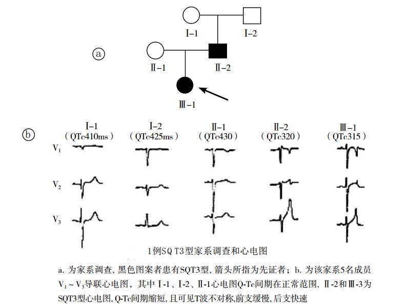 1例SQT3型家系调查和心电图