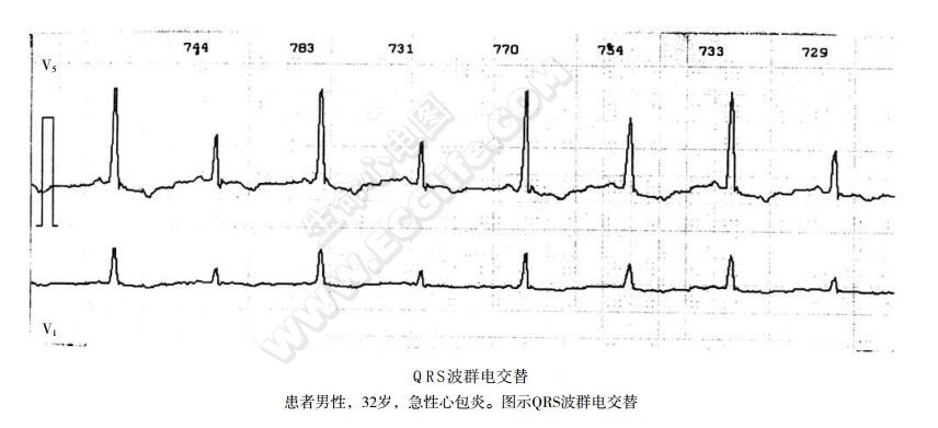 QRS波群电交替