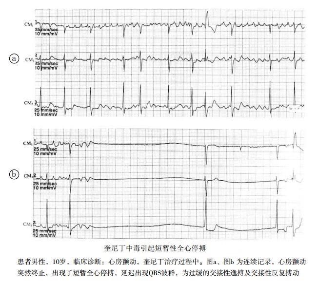 奎尼丁中毒引起短暂性全心停搏