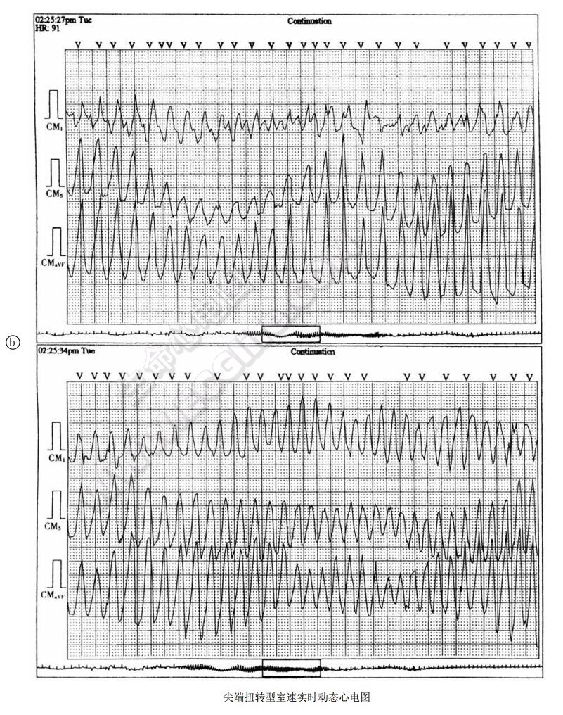 尖端扭转型室速实时动态心电图2