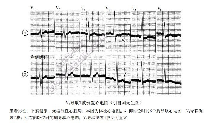 孤立性负T综合征（孤立性T波倒置综合征、心尖现象）