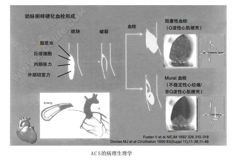 急性冠脉综合征病理生理学