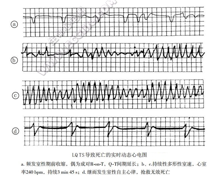 LQTS导致死亡的实时动态心电图