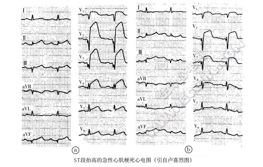 急性冠脉综合征：ST段抬高的急性心肌梗死心电图