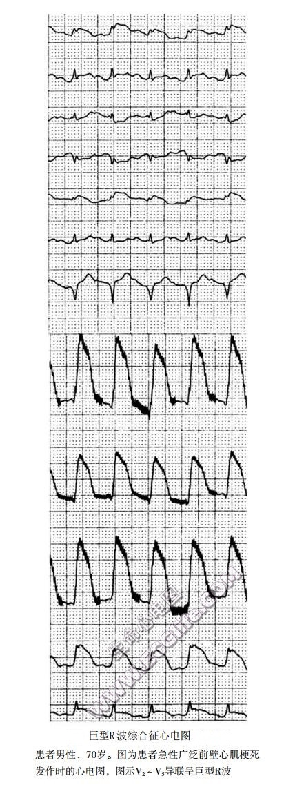巨型R波综合征心电图表现