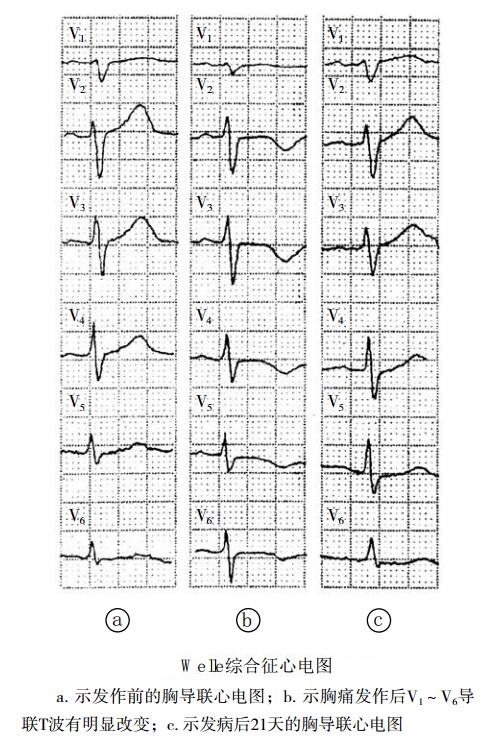 Wellens综合征心电图表现