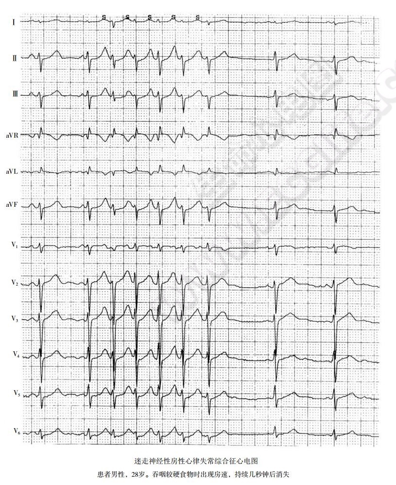 迷走神经性房性心律失常综合征心电图表现2