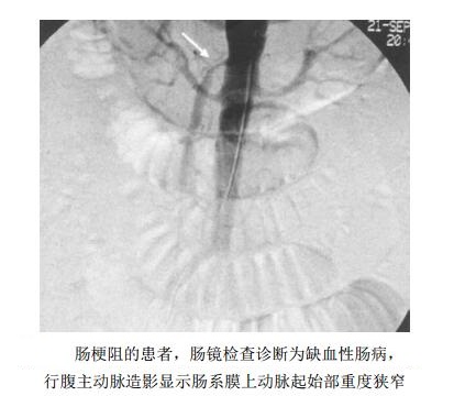 肠梗阻的患者，肠镜检查诊断为缺血性肠病，行腹主动脉造影显示肠系膜上动脉起始部重度狭窄