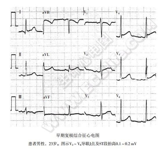 早期复极综合征