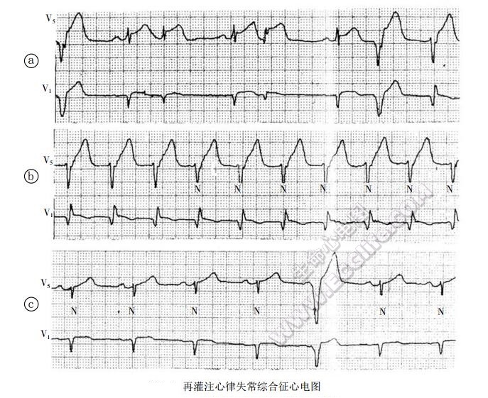 再灌注综合征：再灌注心律失常心电图表现