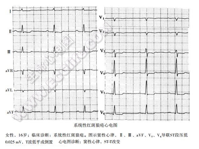 系统性红斑狼疮心电圈