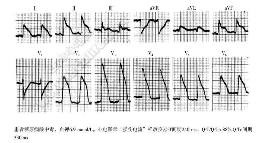 高钾血症致SQTS